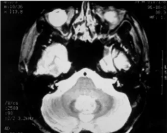 Fig. 2. A T2-weighted axial brain MRI image showing no tu- tu-morous lesions at bilateral cerebellopontine angles
