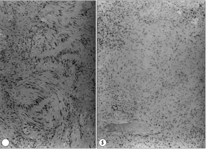 Fig. 3. Intraoperative findings under operating microscope showing numerous nodular yellowish masses  attac-hed to the nerve roots along the rootlets
