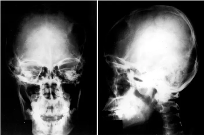 Fig. 1. The preoperative skull AP and lateral film showing a large skull defect at left frontal skull