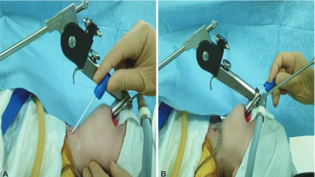 Fig. 1.  Representative photos of bacterial swab culture procedure in pediatric patient with tracheostomy