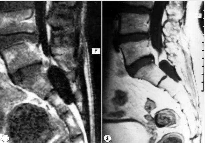Fig. 1. A：Case 1. Sagittal gadolinium-enhanced T1-weighted MR image demonstraing a nonenhanceing cystic mass at level  of S1-2