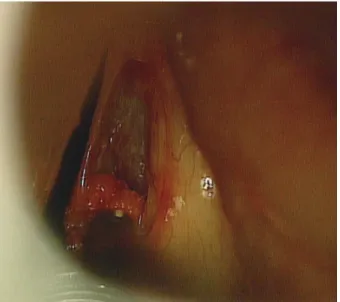 Fig. 1.  Laryngoscopic finding. A Initial laryngoscopy showed single  smooth-surfaced lesion of right vocal cord.