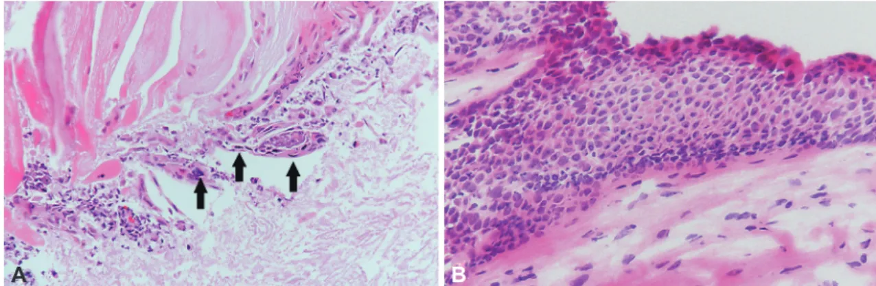 Fig. 3.  Histopathologic findings (hematoxylin and eosin staining, ×400). A: Microscopically, keratinizing atypical squamous cells with nuclear  pleomorphism, hyperchromasia and high nucleus/cytoplasm ratio are scattered in necrotic background