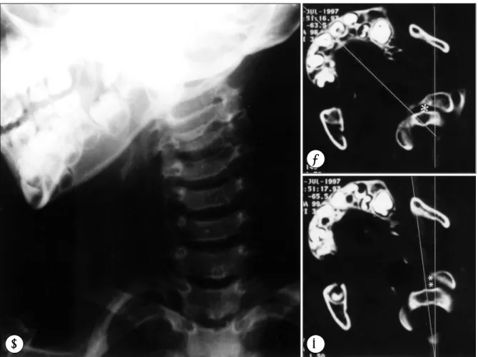 Fig. 1. Case 1. Plain cervical AP radiograph showing severe rotatory deformity to the right side(A)