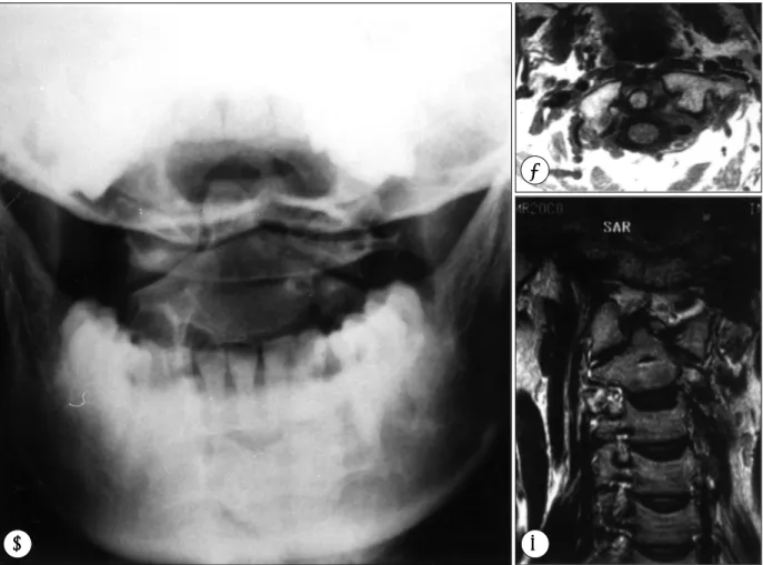 Fig. 3. Case 3. Open mouth radiograph(A) and axial(B) and coronal(C) image of MR showing asymmetrical atlanto-axial  intervals with subluxation