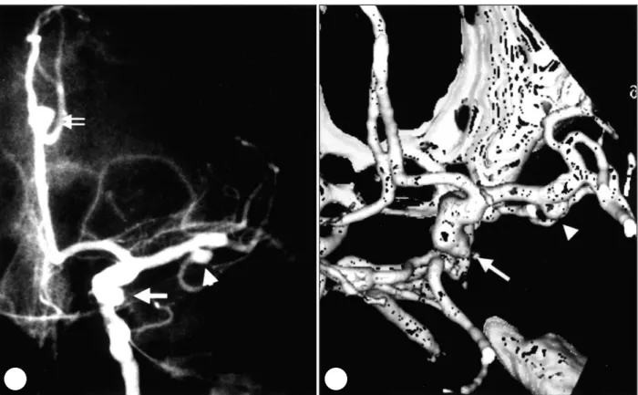 Fig. 1.  A：Left internal carotid angiogram showing multiple aneurysms located in posterior communicating artery(arrow- artery(arrow-head), middle cerebral artery(arrow) and pericallosal artery bifurcation(double arrow)