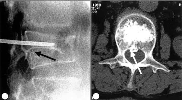 Fig. 2. Case 5(female, L2 compression fracture due to ve-hicle accident 8days before the procedure)