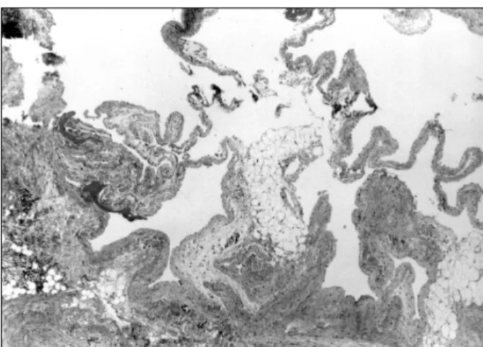 Fig. 4. There are multiple irregular thick-and thin-walled, small and large blood vessles showing intimal thickening (×200, H &amp; E)