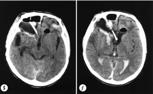 Fig. 4. Postoperative computerized tomography obtained 3 days after operation revealing that most of the hematoma was removed and the ventricular drainge tube was exactly placed in the right foramen of Monro
