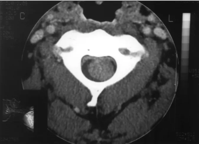 Fig. 1. A computerized tomographic section shows round- round-shaped, isodense mass lesion on C2 level