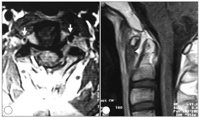 Fig. 1. Lateral radiographs showing C1-2 instability. Atlanto-dental interval is 2mm during neck extension(A) and 7mm during  neck flextion(B)