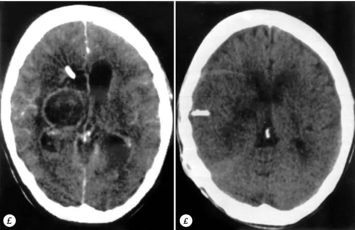 Fig. 1. A：On enhanced CT scan, extensive ependymitis showing as a thin contrast enhancement along the ventricular wall  and previous hematoma