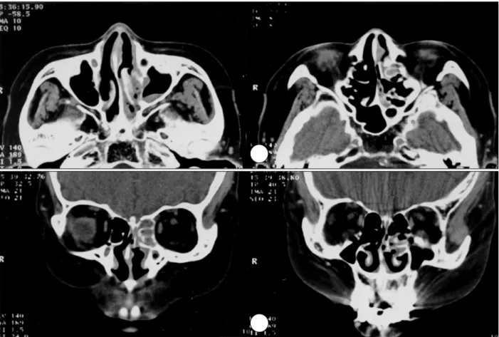 Fig. 1. PNS CT axial(A) and coronal(B) images；Irregular shaped soft tissue density materials are seen in the left nasal cavity,  superior and middle meatus, ethmoidal sinus and maxillary sinus without bony destruction or air-fluid level