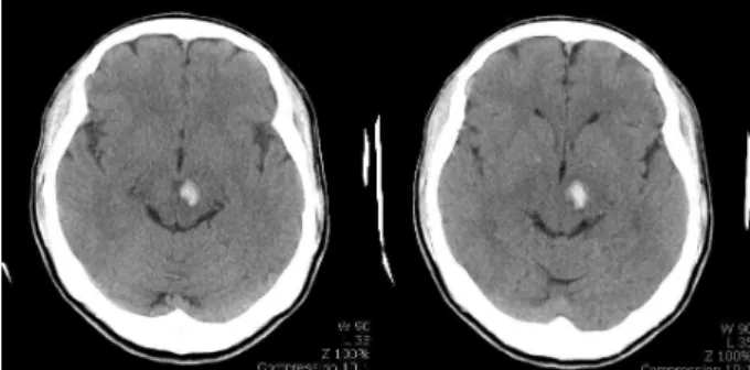 Fig. 1. Brain CT. The brain CT of the onset day demonstrates hemorrhage in left midbrain and thalamus.