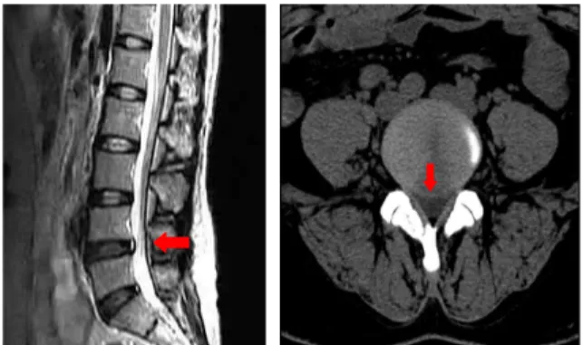 Fig. 4. Lumbar MRI and CT of Patient 4
