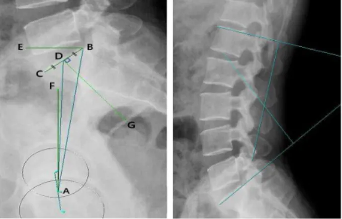 Fig. 1. Pelvic parameters. ∠CBE: