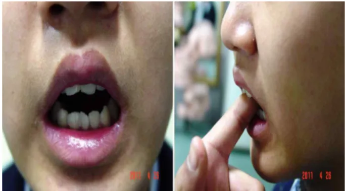 Fig. 1. 2011.4.26 mouth opening range 10 mm.