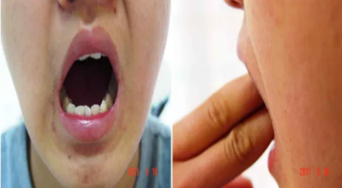 Fig. 2. 2011.5.16 mouth opening range 30 mm.