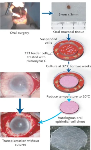 그림 4. Panel shows the removal of oral mucosal tissue (3 by 3 mm) from patient’s cheek