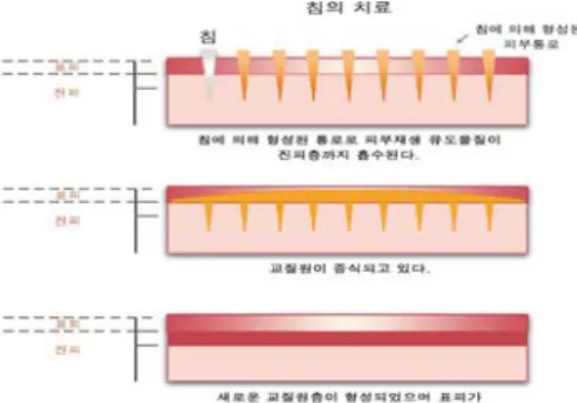 Fig.  3.  Differents  of  medication  absorption  of  common  skin  and  after  microneedle  treatmented  skin 28)