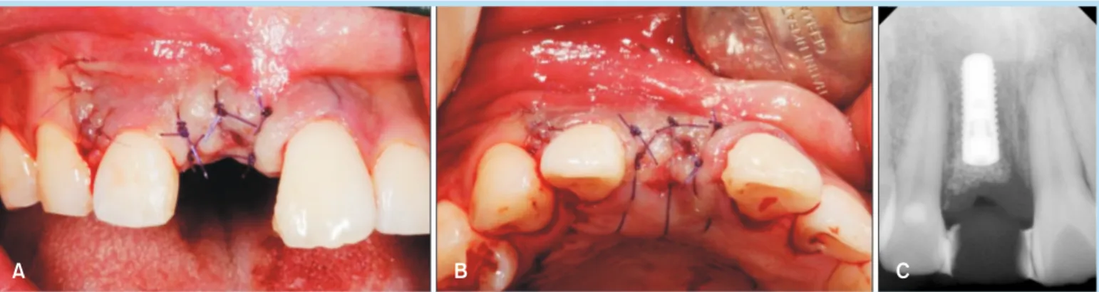 Fig. 7. 	(A)	Good	healing	of	hard	and	soft	tissue	4	months	postoperatively.	(B)	Subepithelial	connective	tissue	graft	was	 harvested	from	the	palatal	donor	site.	(C)	Insertion	of	a	healing	abutment	and	sutured.