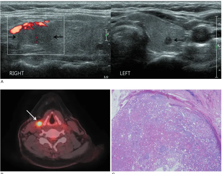 Fig.  1.  A.  A small marked hypoechoic nodule with taller-than-wide character in the left thyroid lobe was confirmed as a papillary carcinoma
