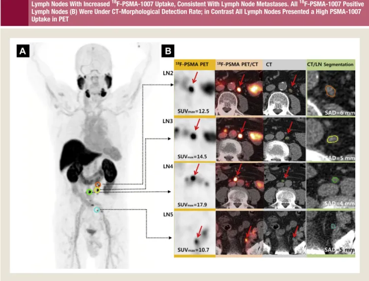 Figure 1 (A) Fluorine-18 ( 18 F)-Prostate-Speciﬁc Membrane Antigen (PSMA)-1007 Maximum Intensity Projection-Positron Emission Tomography (PET)/Computed Tomography (CT) in a Patient With Biochemical Recurrence After Prostatectomy Presented Lymph Nodes With 