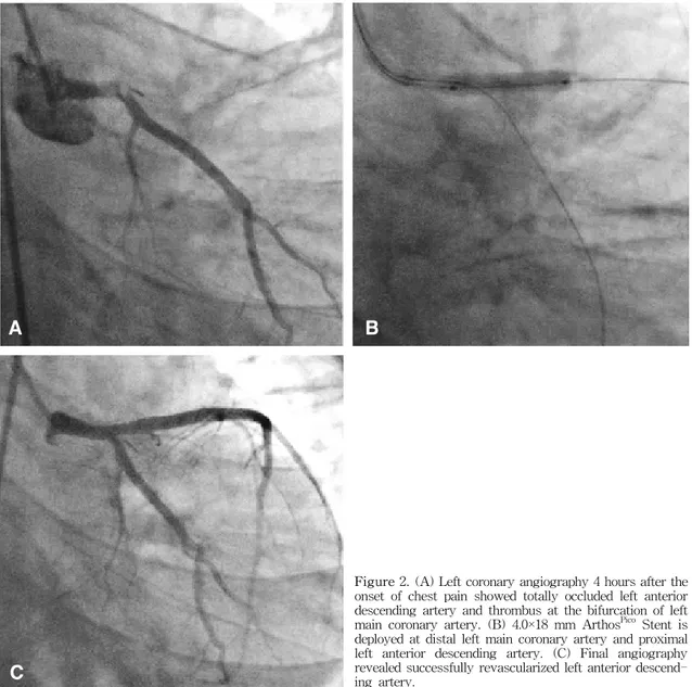 Figure  2.  (A)  Left  coronary  angiography  4  hours  after  the  onset  of  chest  pain  showed  totally  occluded  left  anterior  descending  artery  and  thrombus  at  the  bifurcation  of  left  main  coronary  artery