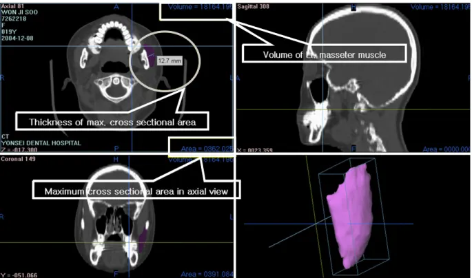 Fig 2. Measurement of the masseter muscle angle. Fig 1. Measurement of total volume, maximum cross-sectional area in axial view of the masseter muscle and thick-ness of the maximum cross sectional area