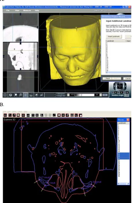 Fig. 2. A : Facial soft tissue thickness measurement on three-dimensional image model by V-works TM 4.0