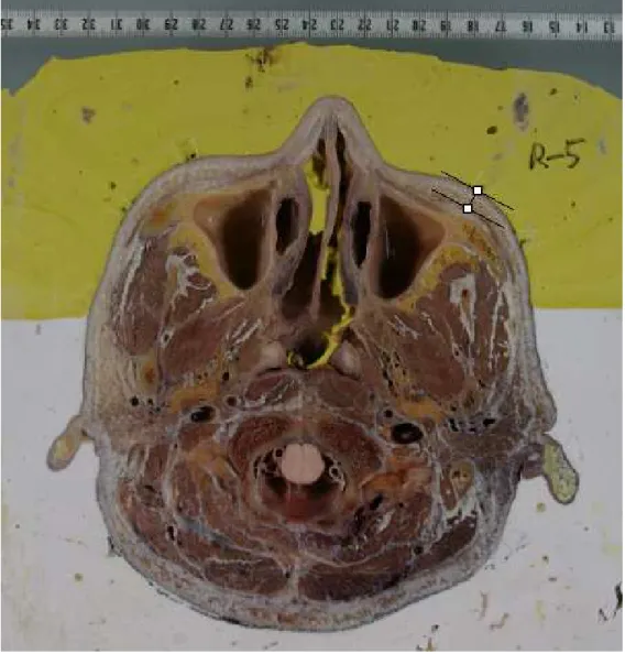 Fig. 3. Measurement on the picture by Imagepro TM . The line is drawn perpendicular to the skin.