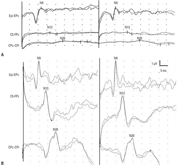 Fig. 1. Serial median nerve SSEP studies using the same filter settings. (A) At admission, the observed increased duration of positive de- de-flection with a low amplitude negative peak of the bilateral brachial plexus (Erb’s point) with barely discernible