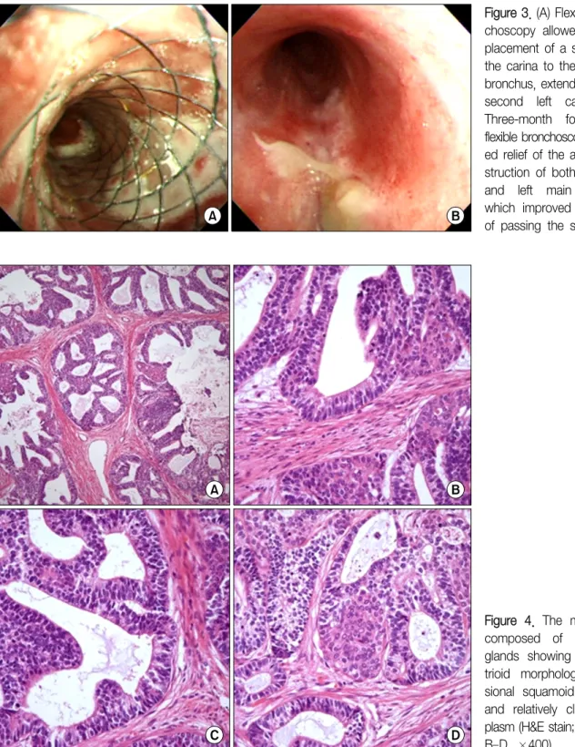 Figure  4.  The  mass  was  composed  of  numerous  glands  showing   endome-trioid  morphology,   occa-sional  squamoid  morules,  and  relatively  clear   cyto-plasm (H&amp;E stain; A, ×100; B–D,  ×400).