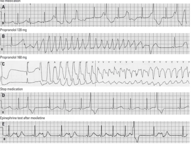 Fig. 3. The ECG documented events during epinephrine provocation test. (A) Baseline epinephrine provocation test showing non-sus-