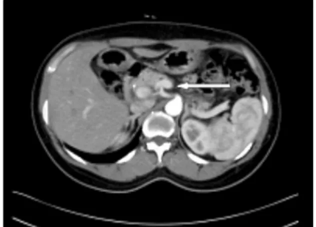 Fig. 2. Sellar MRI shows 0.9 × 0.6 mm sized microade-