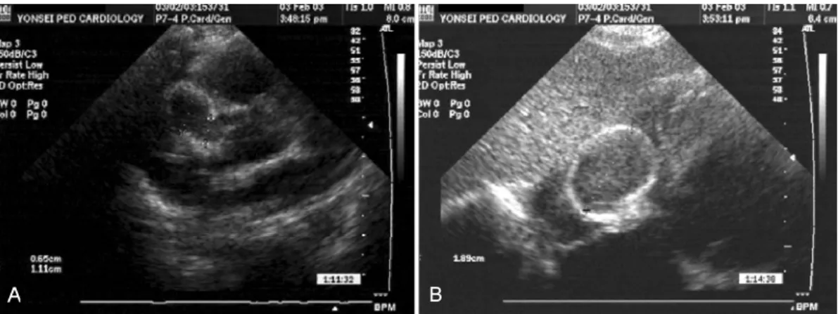 Fig. 1. Echocardiogram on day 21, showed giant aneurysm of right coronary artery (A) with a large mural thrombus (B) as a sequela of Kawasaki disease.