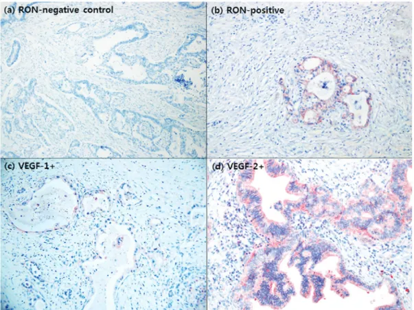 Figure 4. Oncological effect of RON expression in resected left‑sided pancreatic cancer