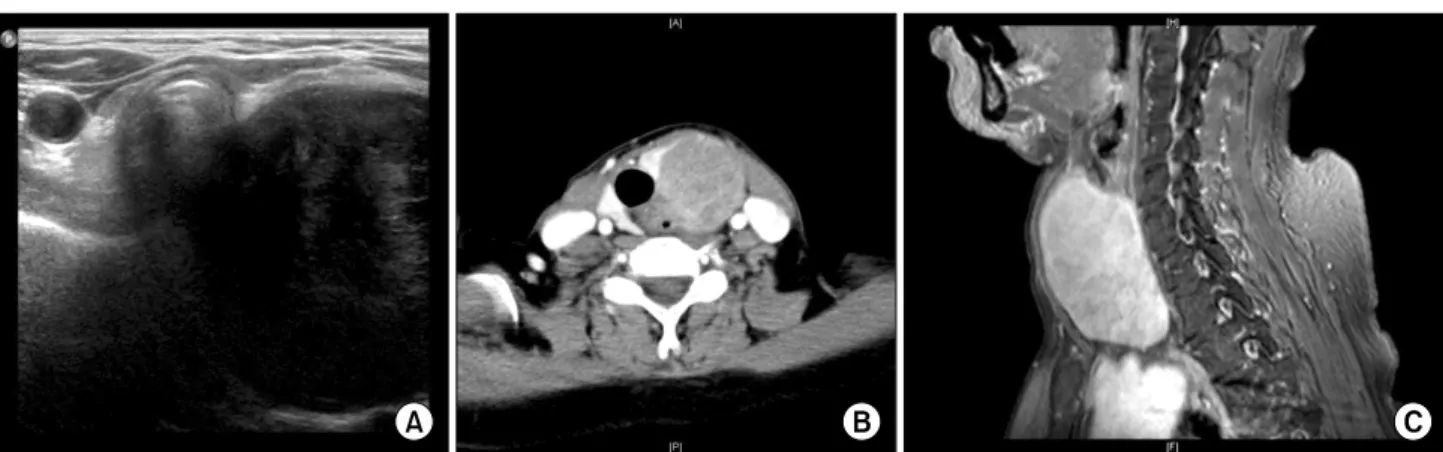 Fig.  1.  Preoperative  imaging  study.  (A)  Preoperative  ultrasonography  depicted  a  well-defined  solid,  hypoechoic  mass  in  the  inferior  portion 