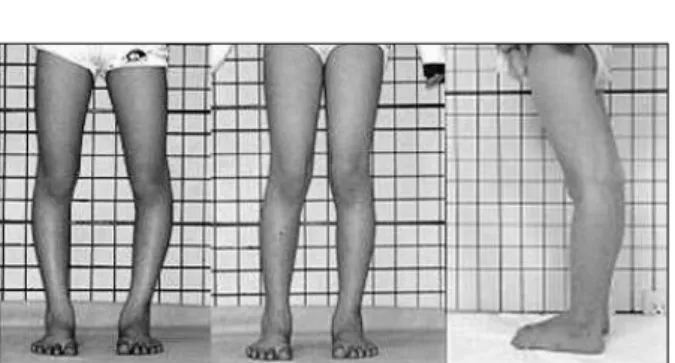 Fig. 3. A 21-year-old patient in Group 2. When the patellar point was forward, tibia vara ensued.