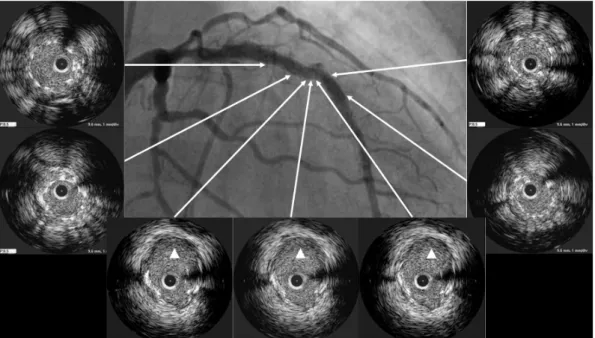 Fig. 2. IVUS at follow-up angiography confirmed a complete stent fracture with coronary artery aneurysm (arrow heads)