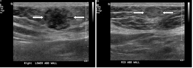 Fig. 1. A 64-year-old woman with a right partial mastectomy performed 3 year ago.