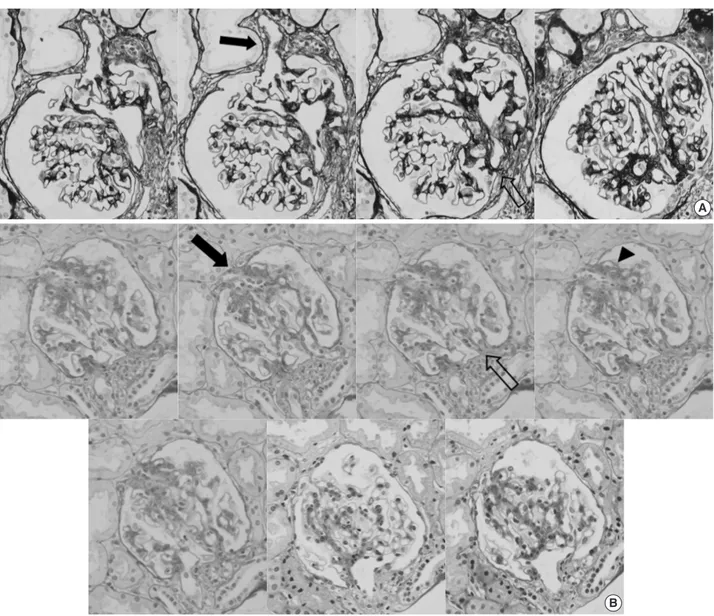 Fig. 1. Consecutive photos of two glomeruli showing extra-efferent vessel formation in focal segmental glomerulosclerosis-like IgA nephrop- nephrop-athy