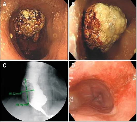 Fig. 1. (A, B) Endoscopic view 