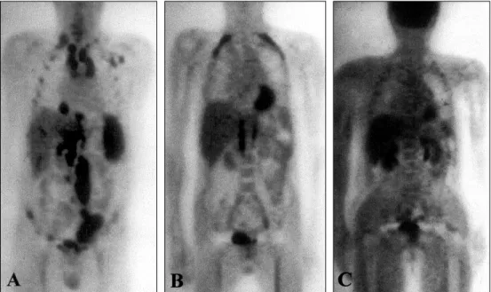 Fig. 2. Serial follow up images of 18 FDG-PET scans. A. The initial 18 FDG-PET scan showed massive areas of hot uptake