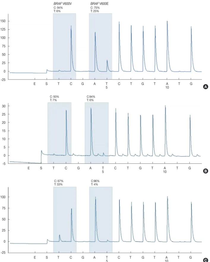 Fig. 3. BRAF gene mutation analysis of each tumor tissue by pyrosequencing. The BRAF V600E (c.1799T &gt;A) and a low level of the BRAF  V600V (c.1800G &gt;A) mutation are found in the initially diagnosed papillary thyroid carcinoma (A) and poorly different