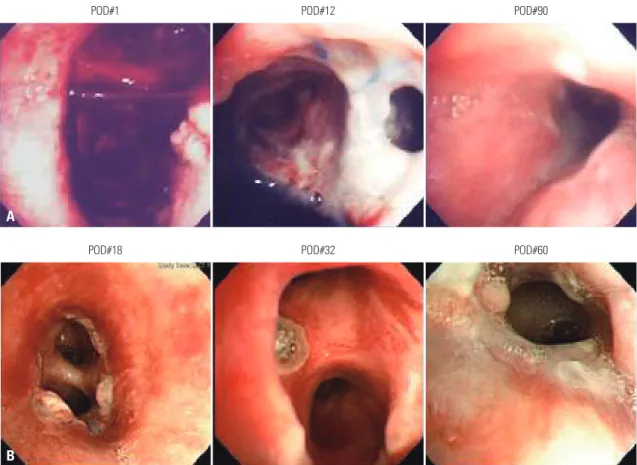 Fig. 2.  Representative photographs of early anastomotic airway complications. (A) A case of early airway complication presenting fistula at anasto-