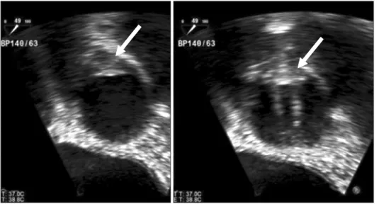 Fig. 2. Transesophageal echocardiography 
