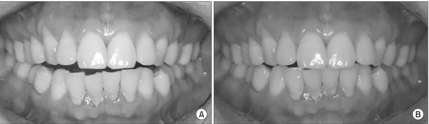 Fig. 1. Open bite reduced group when forced on chin top. A. Not forced on chin top. B