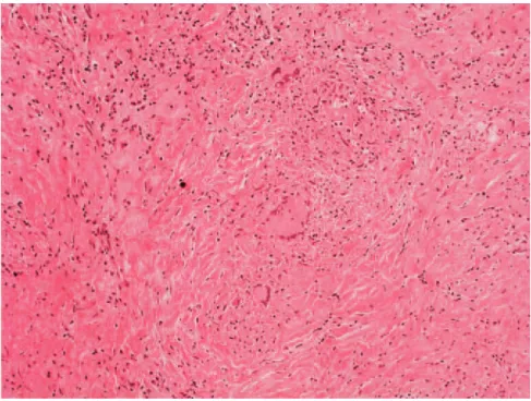 Figure 2. Pathology showed chronic granulomatous inflammation with  case-ous necrosis consistent with