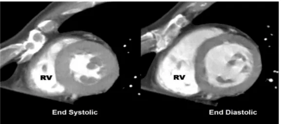 Figure  1.  Short-axis  MPR  images  in  end-diastolic  and  end-systolic  phase.